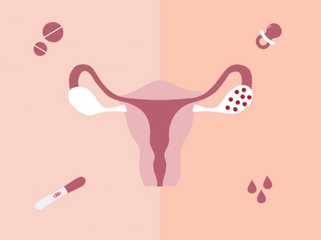 1.What is Polycystic Ovary Syndrome PCOS?